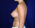 breast_augmentation_photo_outcomes_1006.JPG