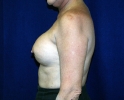 Breast reconstruction pictures _replacement_203.JPG