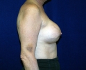 Breast reconstruction pictures _replacement_205.JPG