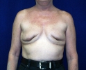 Breast reconstruction pictures replacement_206.JPG