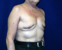 Breast reconstruction pictures _replacement_207.JPG