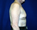 Breast reconstruction pictures _replacement_208.JPG
