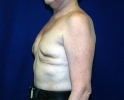Breast reconstruction pictures _replacement_209.JPG