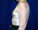 Breast reconstruction pictures _replacement_210.JPG