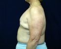 Breast reconstruction pictures _replacement_302.JPG