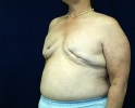 Breast reconstruction pictures _replacement_303.JPG