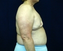 Breast reconstruction pictures _replacement_305.JPG