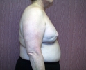 Breast reconstruction pictures _replacement_307.JPG