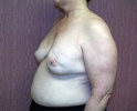 Breast reconstruction pictures replacement_308.JPG