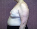 Breast reconstruction pictures replacement_309.JPG