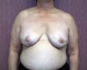 Breast reconstruction pictures _replacement_310.JPG