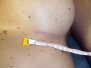 Breast augmentation scar photos 14*