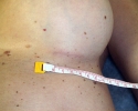 Breast augmentation scar photos _marks201.JPG