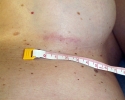 Breast augmentation scar photos _marks202.JPG