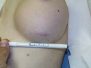 Breast augmentation scar photos 16*