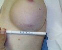 Breast augmentation scar photos marks601.jpg