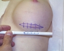 Breast augmentation scar photos marks602.jpg