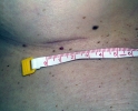 Breast augmentation scar photos _marks01.JPG
