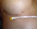 Breast augmentation scar photos marks02.JPG