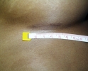 Breast augmentation scar photos marks03.JPG