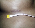 Breast augmentation scar photos marks04.JPG