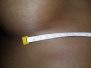 Breast augmentation scar photos 2*