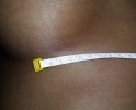 Breast augmentation scar photos 101.JPG