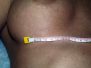 Breast augmentation scar photos 21*