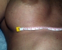 Breast augmentation scar photos marks801.JPG