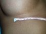 Breast augmentation scar photos 36*