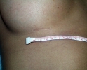 Breast augmentation scar photos _marks7001.JPG