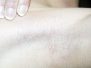 Breast augmentation scar photos 41*
