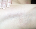 Breast augmentation scar photos _tax101.JPG