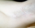 Breast augmentation scar photos tax102.JPG