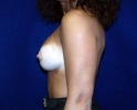 Breast augmentation scar photos _pa302.JPG