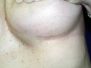 Breast augmentation scar photos 9*