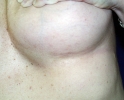 Breast augmentation scar photos marks302.JPG