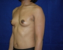 Breast augmentation photos _settle708.JPG