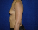 Breast augmentation photos _settle709.JPG