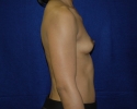 Breast augmentation photos _settle710.JPG