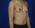 Breast augmentation photos _settle711.JPG