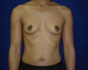 Breast augmentation photos _settle713.JPG
