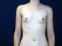 Breast augmentation photos 144*