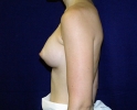 breast_augmentation_photo_torso903.JPG