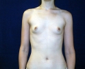 breast_augmentation_photo_torso906.JPG