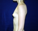 breast_augmentation_photo_torso910.JPG