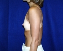 breast_augmentation_photo_thin_104.JPG