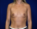 breast_augmentation_photo_torso601.JPG