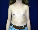 breast_augmentation_photo_thin_306.JPG