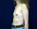 breast_augmentation_photo_thin_308.JPG